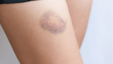 Photo of बिना चोट लगे क्यों पड़ जाते हैं शरीर पर नीले निशान?