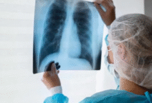 Photo of कमजोर इम्युनिटी और खराब जीवनशैली दे रही टीबी को न्योता